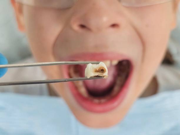 Best Emergency Treatment for Oral Infections in New Baltimore, MI